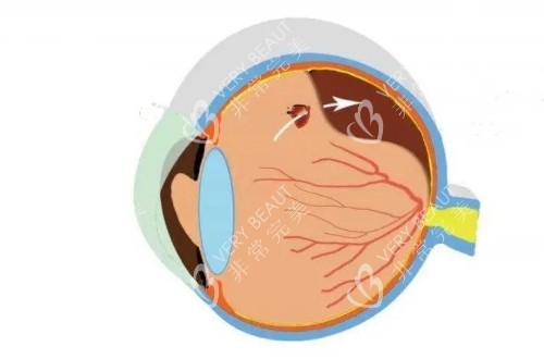 視網(wǎng)膜穿孔以及脫落的卡通示意圖