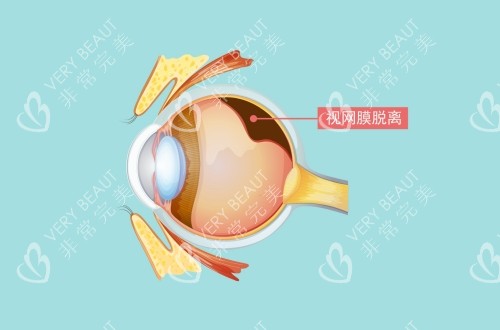 視網(wǎng)膜脫離的卡通示意圖