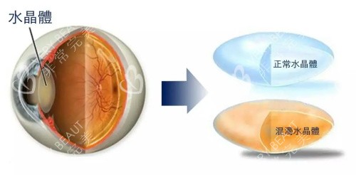 眼部正常水晶体和浑浊水晶体的区别