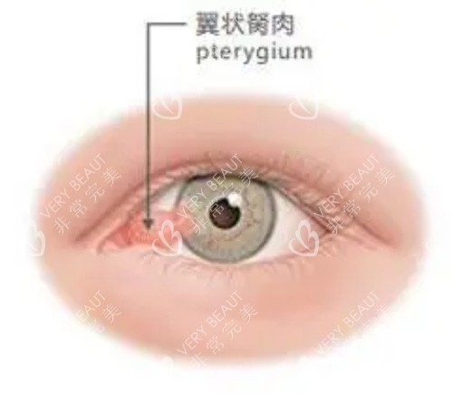 眼睛胬肉示意圖