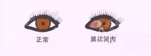 正常眼睛和眼睛胬肉的眼睛對(duì)比