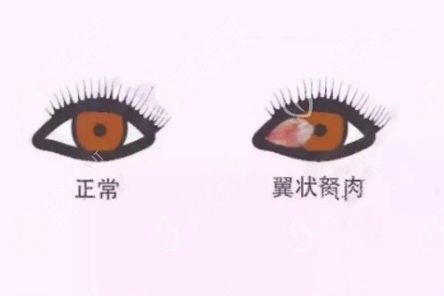 正常眼睛、翼狀胬肉卡通對(duì)比圖
