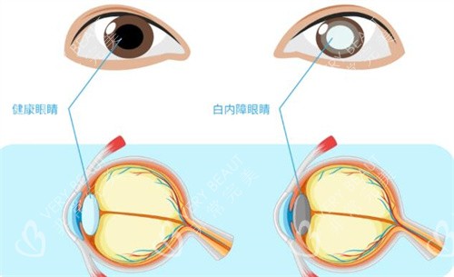 白內(nèi)障和正常眼睛對比