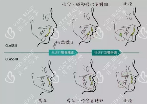 正颌手术示意图