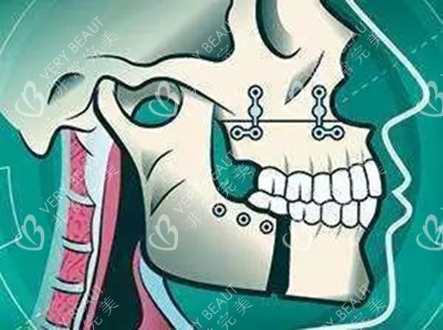 正颌手术示意图