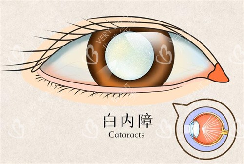 白内障卡通图