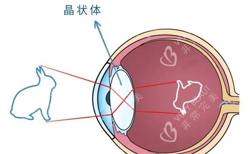 白内障特点示意图