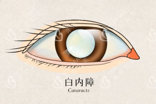 白内障卡通图片展示