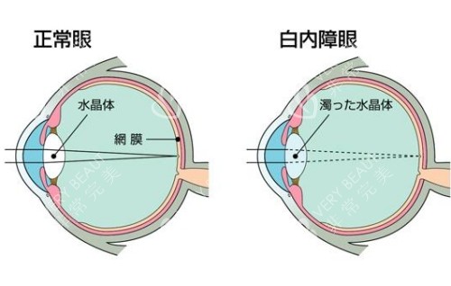 正常眼與白內(nèi)障眼對(duì)比圖