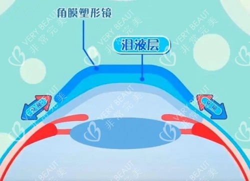 佩戴OK镜眼球示意图