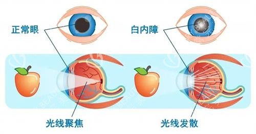 白内障光线聚集示意图