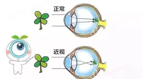 近视眼的状态示意图