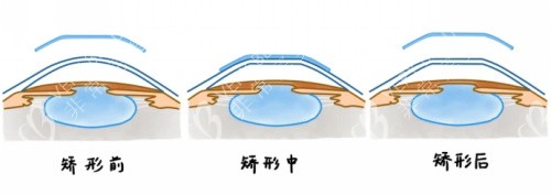 佩戴OK镜矫正前后对比