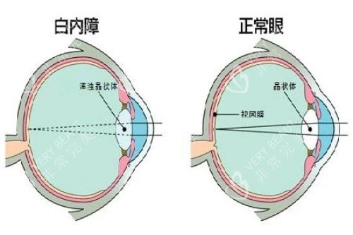 白内障和正常眼对比