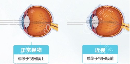 正常视力与近视视网膜成像区别