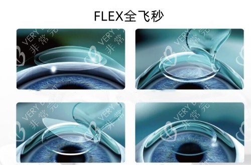 FLEX全飞秒手术的过程示意图
