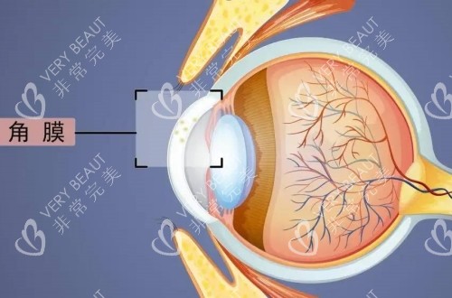 近视矫正的角膜示意图