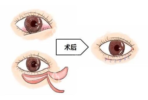 倒睫手术后的成效