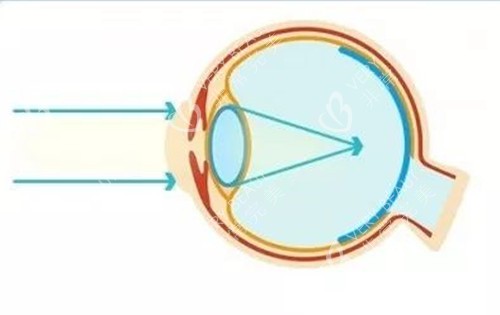 近视成像卡通示意图