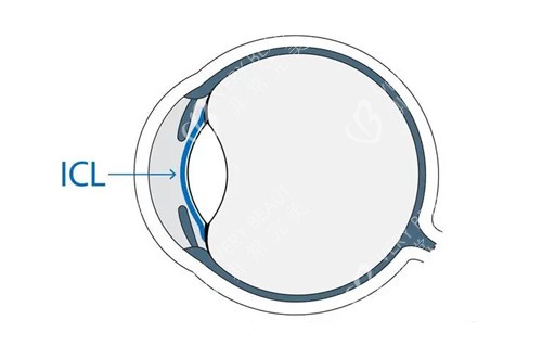 ICL晶体植入位置示意图