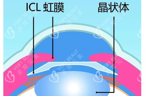 ICL晶體植入眼內(nèi)的側(cè)面解剖示意圖