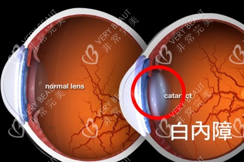 白内障原理图