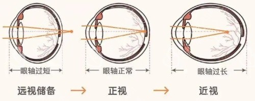 远视近视眼和正常眼对比