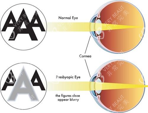 正常视力和老花眼视力的对比
