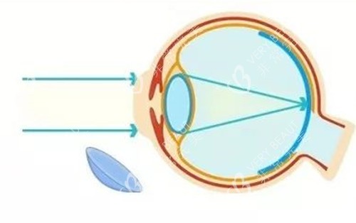 佩戴角膜塑形镜之后成像示意图