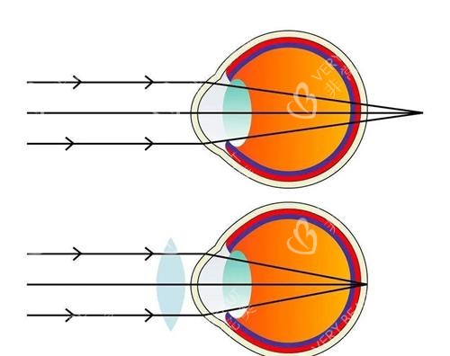 远视眼示意图