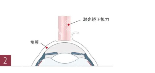 近视眼治疗手术示意图