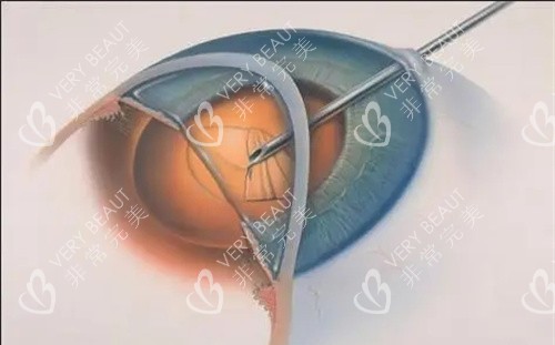 眼球治疗过程图