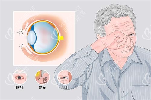 葡萄膜炎的症状