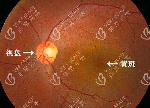 黄斑病变形成照片图
