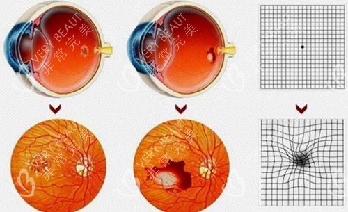 黄斑病变视力呈现展示