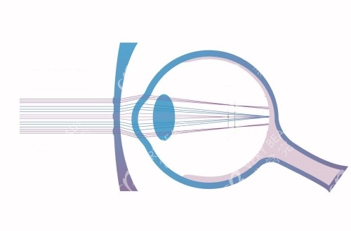 离焦眼镜对视力的控制演示图