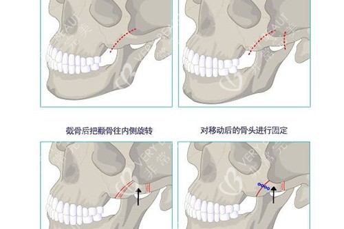 颧骨内推示意图图片