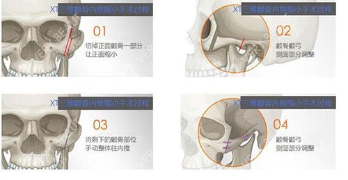 輪廓整形顴骨手術示意圖