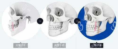 雙鄂手術示意圖