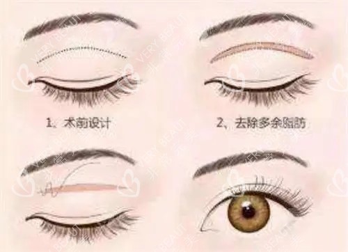 全切雙眼皮簡(jiǎn)易過(guò)程示意圖