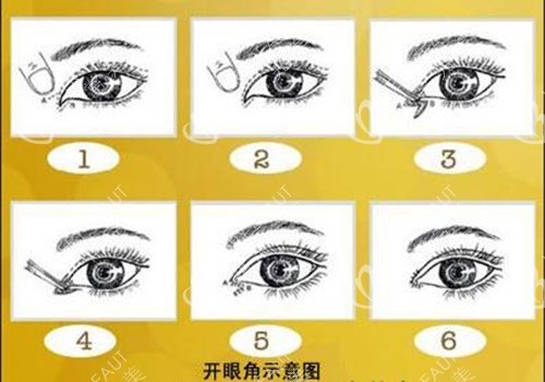 開眼角示意圖