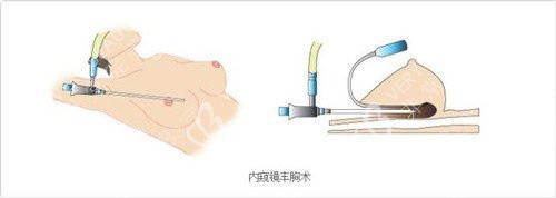 內(nèi)窺鏡隆胸技術(shù)示意圖