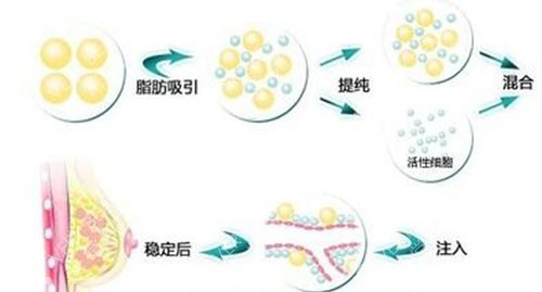 隆胸操作過程示意圖