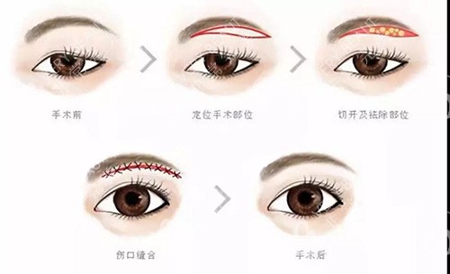 預(yù)約手術(shù)眼袋整形示意圖