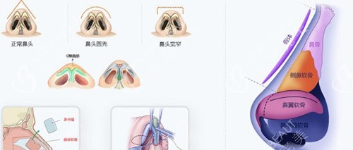 隆鼻步驟過程示意圖