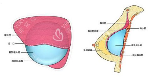 隆胸手術(shù)示意圖