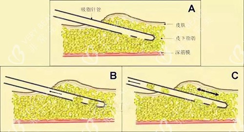 吸脂手術(shù)示意圖