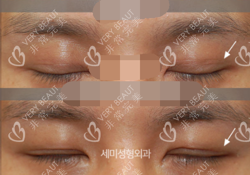 韓國世美整形醫(yī)院眼修復(fù)示意圖