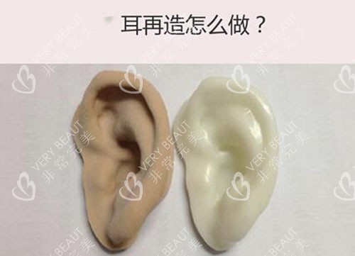 耳再造应该怎么改善