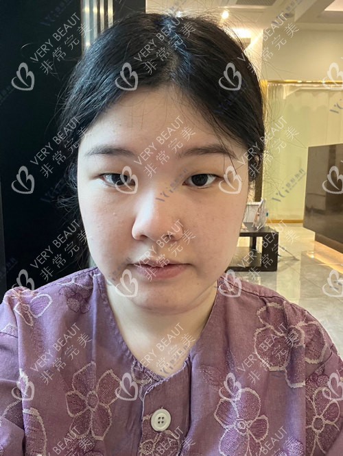 韓國VG整形外科術(shù)前正面